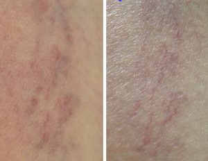 Spider Vein Treatment Cornwall